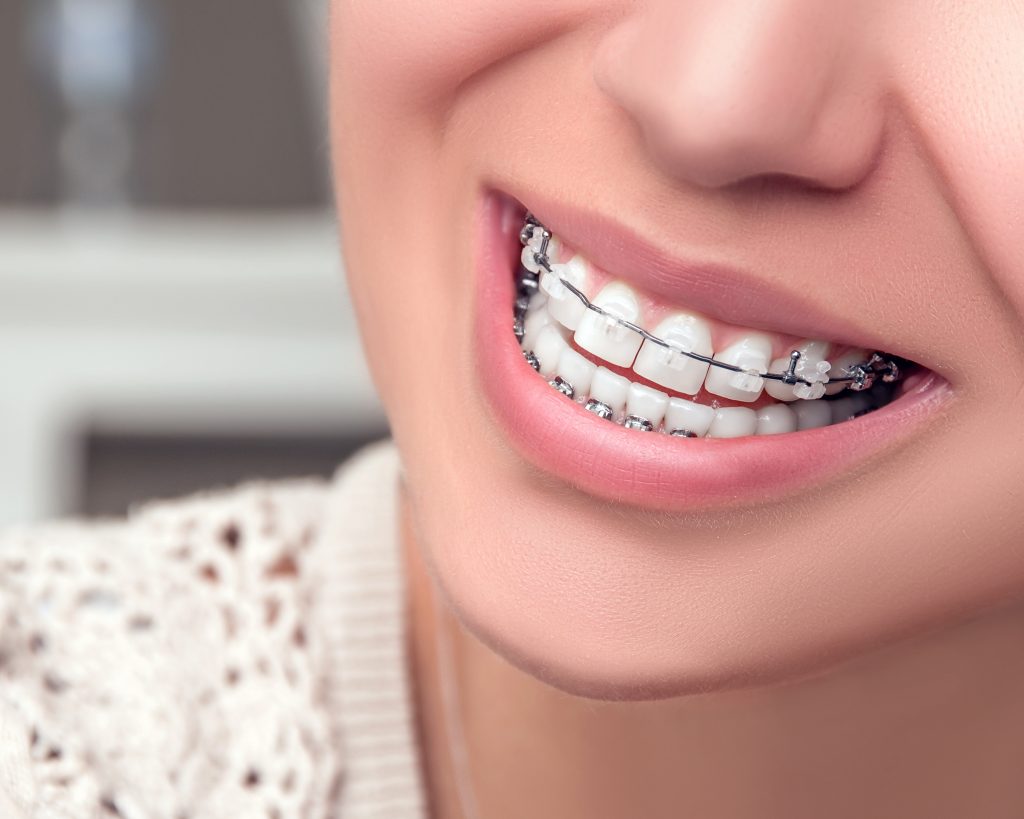 Dental Braces 